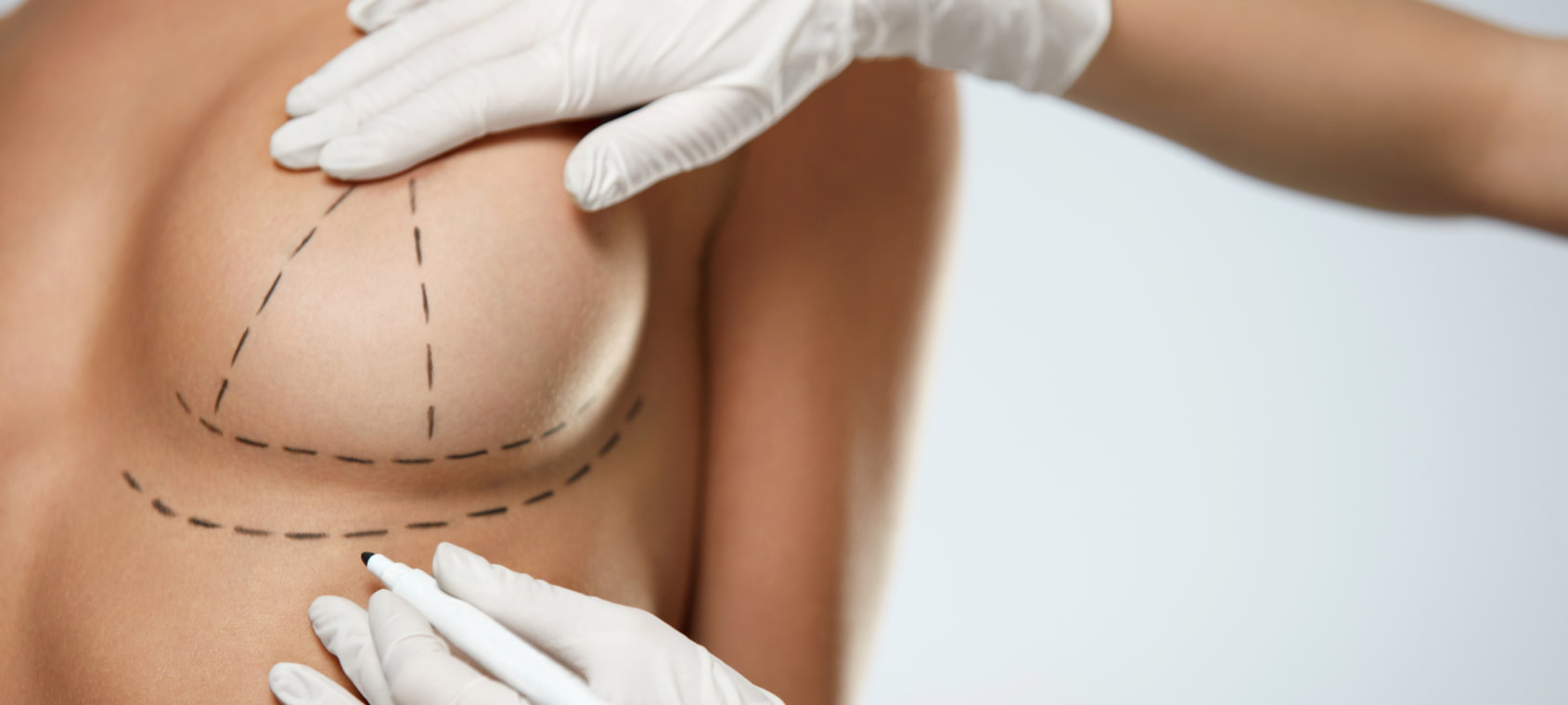 Breast Augmentation with Silicone Implants