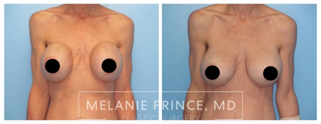 Prince patient before and after of capsular contracture
