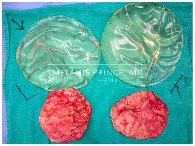 implants that were removed after capsular contracture
